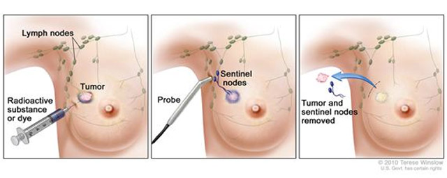 Breast Cancer Tumor or Lump or Lymph