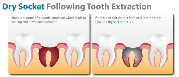 Dry Socket After Teeth Removal - HitBrother Health