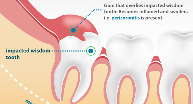 Impacted Wisdom Teeth